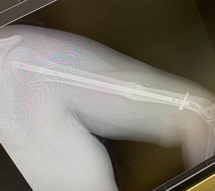 afecto-de-pseudoartrosis-de-humero-paciente-brazo