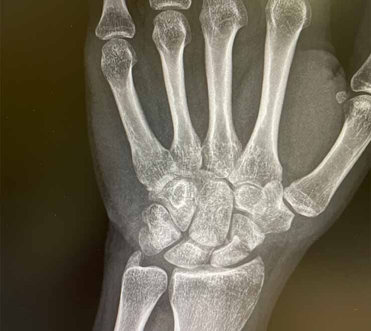 mano-pseudoartrosis-de-escafoides-carpiano